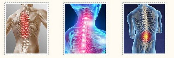 osteohondroza različite kralježnice