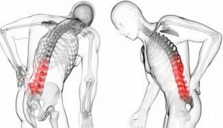 Intervertebralna kila - Komplej s osteohondrozom