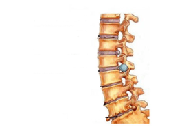Oštećenje kralježnice s cervikalnom osteohondrozom