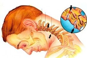 Pinching od živca u kralježnici s cervikalnom osteohondrozom