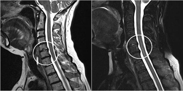 MRI vratne kralježnice