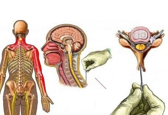 liječenje cervikalne osteohondroze akupunkturom