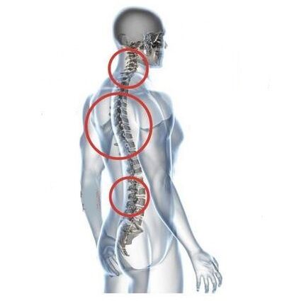 mjesta spinalne osteohondroze
