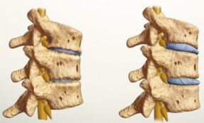 kako izgleda osteohondroza