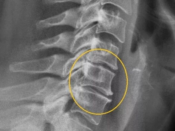 Osteokondroza vratne kralježnice na rendgenskom snimku